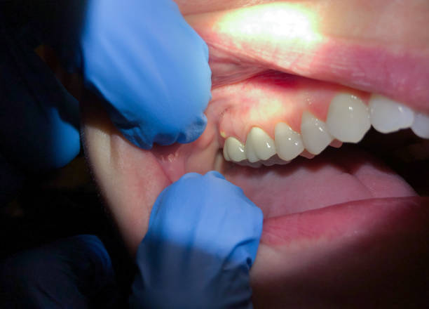 Best Emergency Dental Care for Broken or Chipped Teeth in Columbia, MO