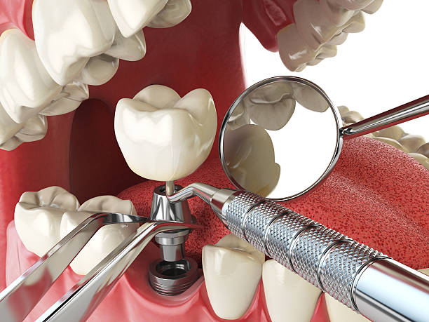 Best Emergency Dental Care for Broken or Chipped Teeth in Columbia, MO